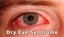 Dry Eye Syndrome